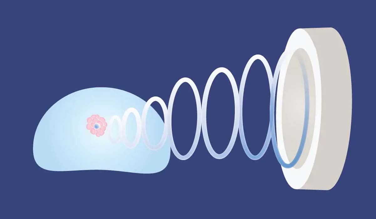 HIFU: Ameliyatsız Prostat Kanseri Tedavisi