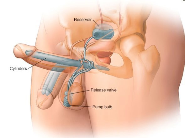 penil protez yerleşimi