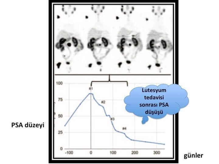 Lutesyum tedavisi sonrası PSA d&uuml;ş&uuml;ş&uuml;