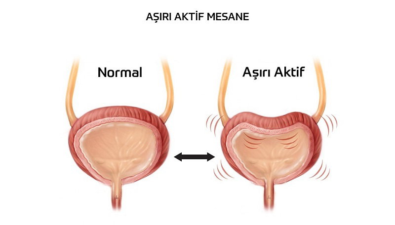 aşırı aktif mesane
