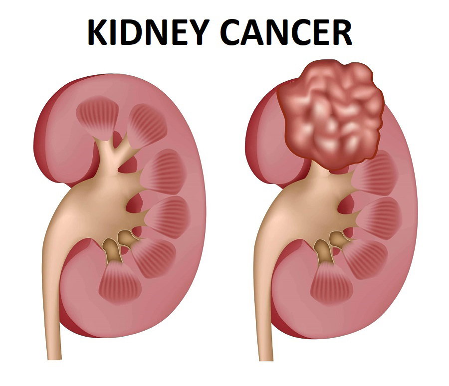 kidney cancer