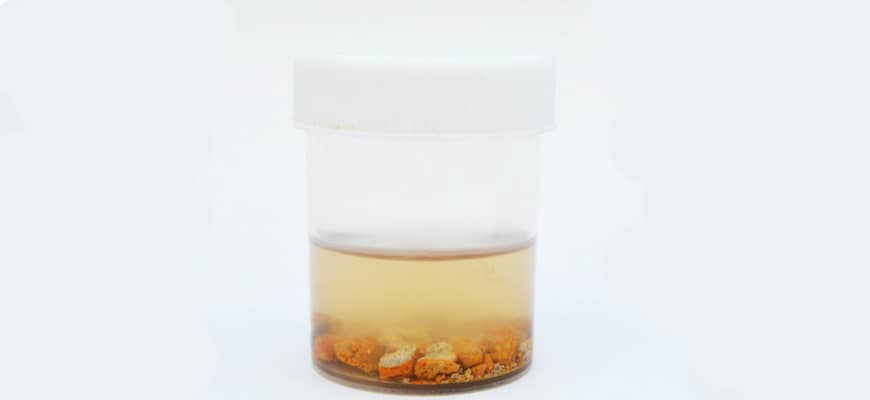 Mesane Taşı Belirtileri, Teşhisi ve Tedavisi