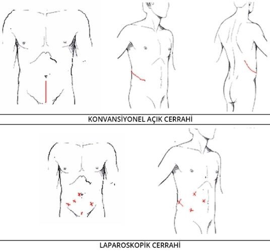 laparoskopik cerrahi