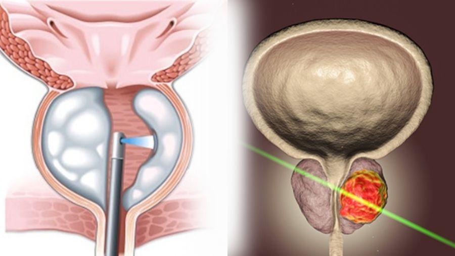 Prostat Tedavisinde Lazer Yöntemleri: HoLEP vs. ThuLEP