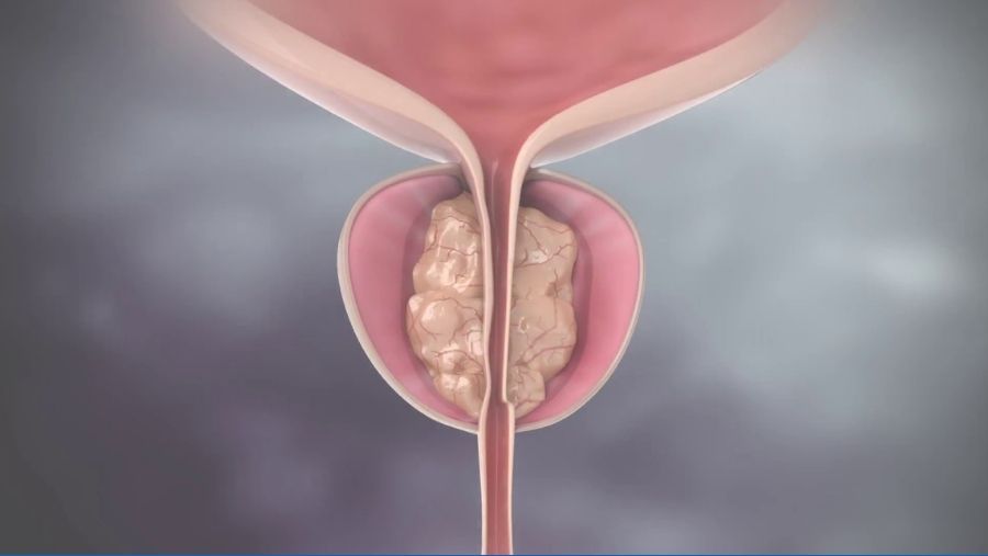 Prostat Embolizasyonu Nedir?