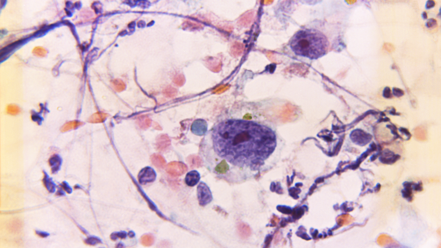 Prostat Kanseri Tedavi Planında CTC Testinin Rolü