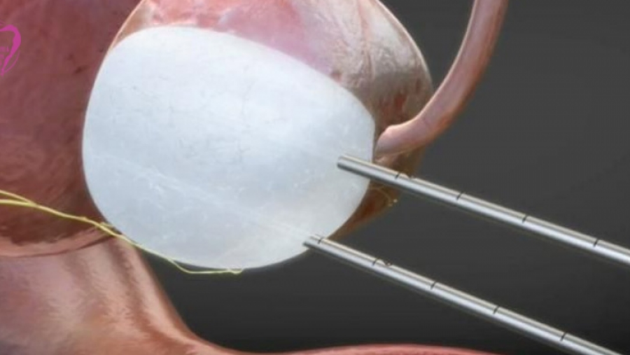 Kriyoterapi Nedir? Faydaları ve Riskleri Nelerdir?