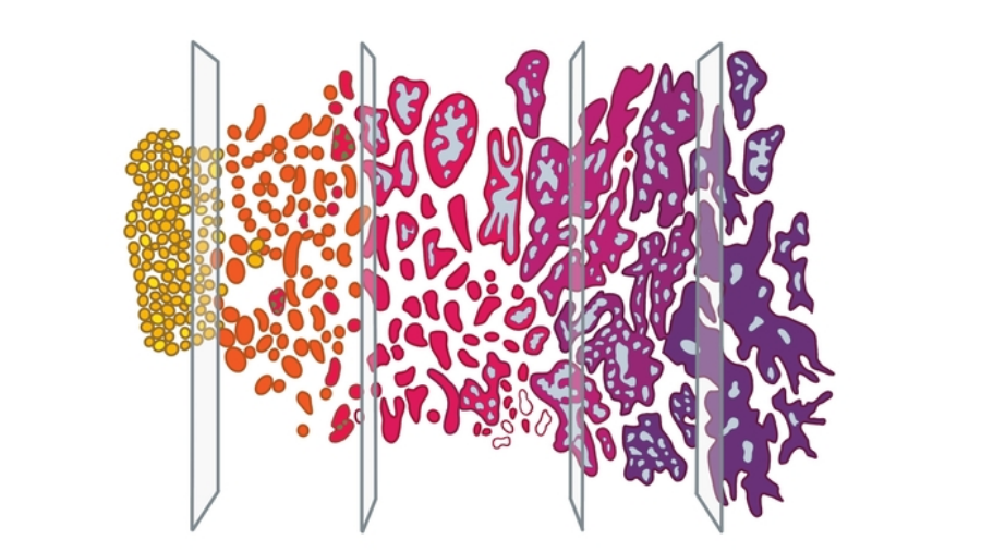 Gleason Skoru Nedir?