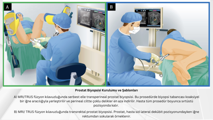 Prostat Biyopsisi