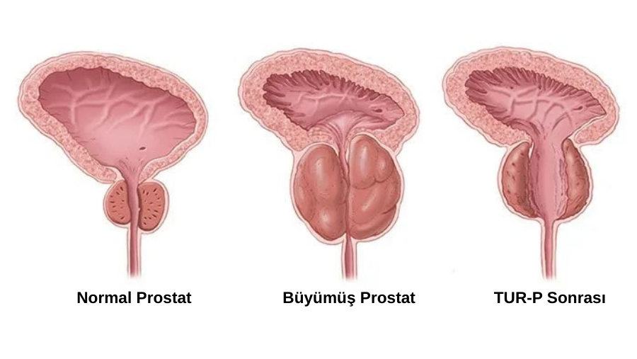 TUR-P Ameliyatı Nedir?