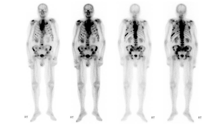 Metastatik Prostat Kanserinde Yeni Dönem