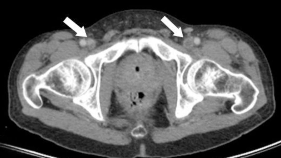 Retroperitoneal Fibrozis Nedir? Belirtileri, Nedenleri ve Tedavisi