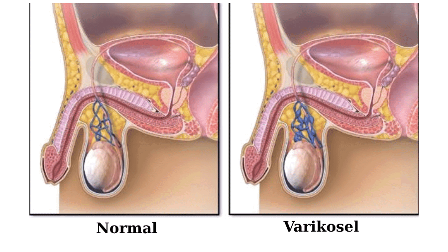 varicocele testicle